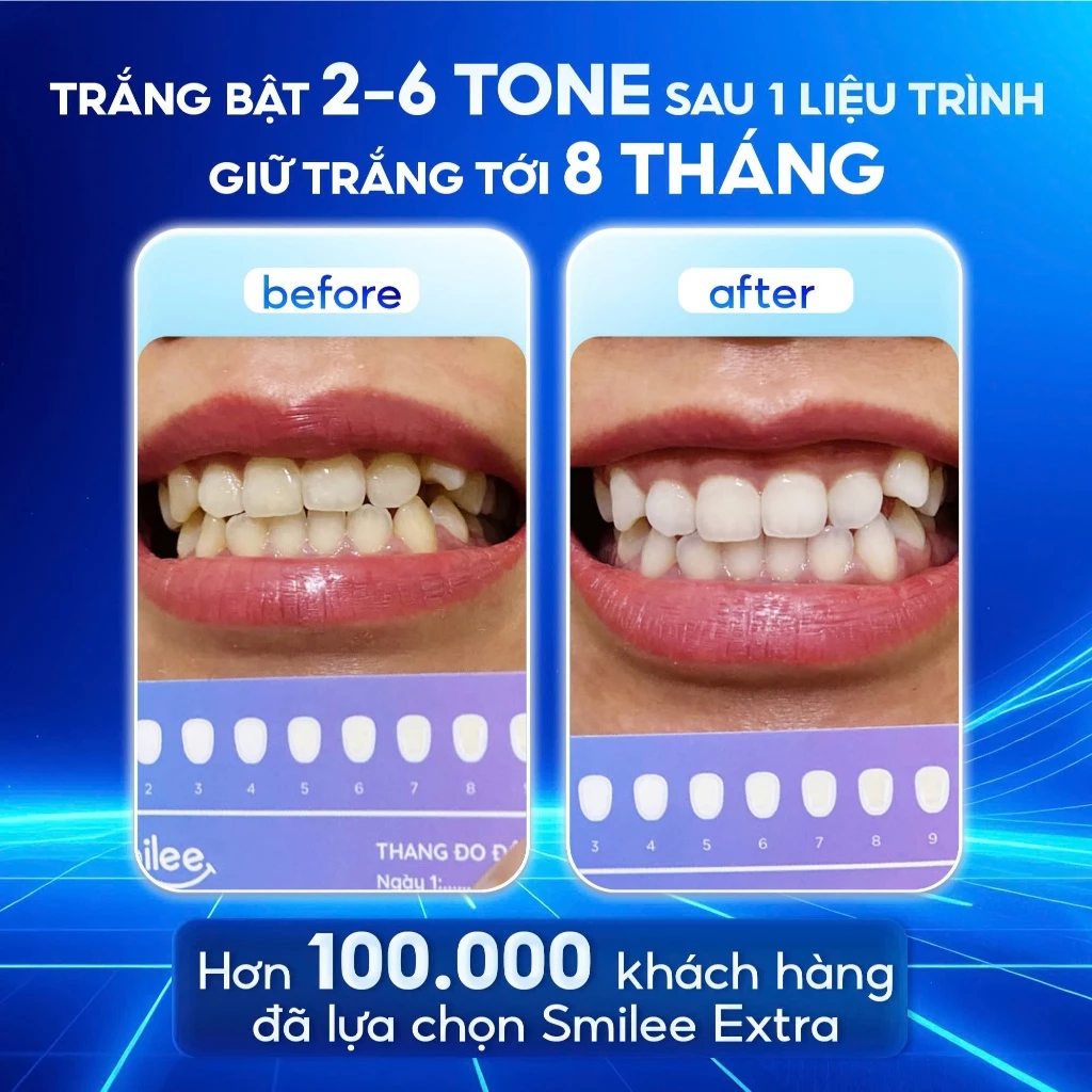 Trắng Răng Smilee Extra